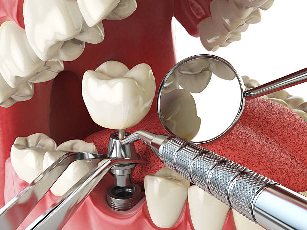 Best Broken or Chipped Tooth Repair in Aberdeen Proving Ground, MD